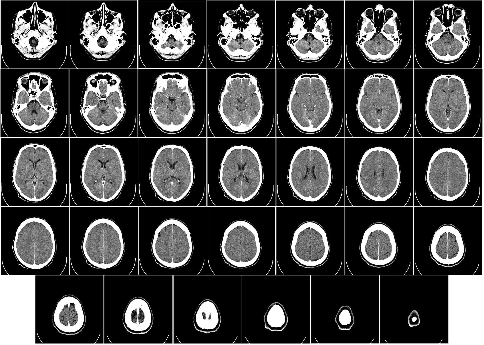 CVC Procedure